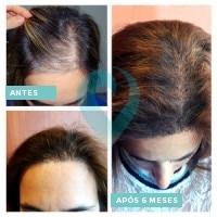 Antes e Depois Liliana Correia