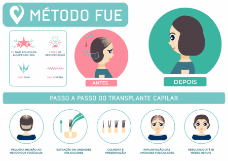 Transplante Capilar Feminino Metodo FUE