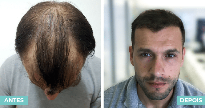 antes e depois carlos loureiro